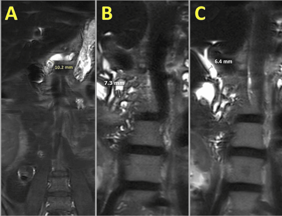Endoscopic Management of Obstructive Chronic Pancreatitis in Dual Organ Transplant Recipient