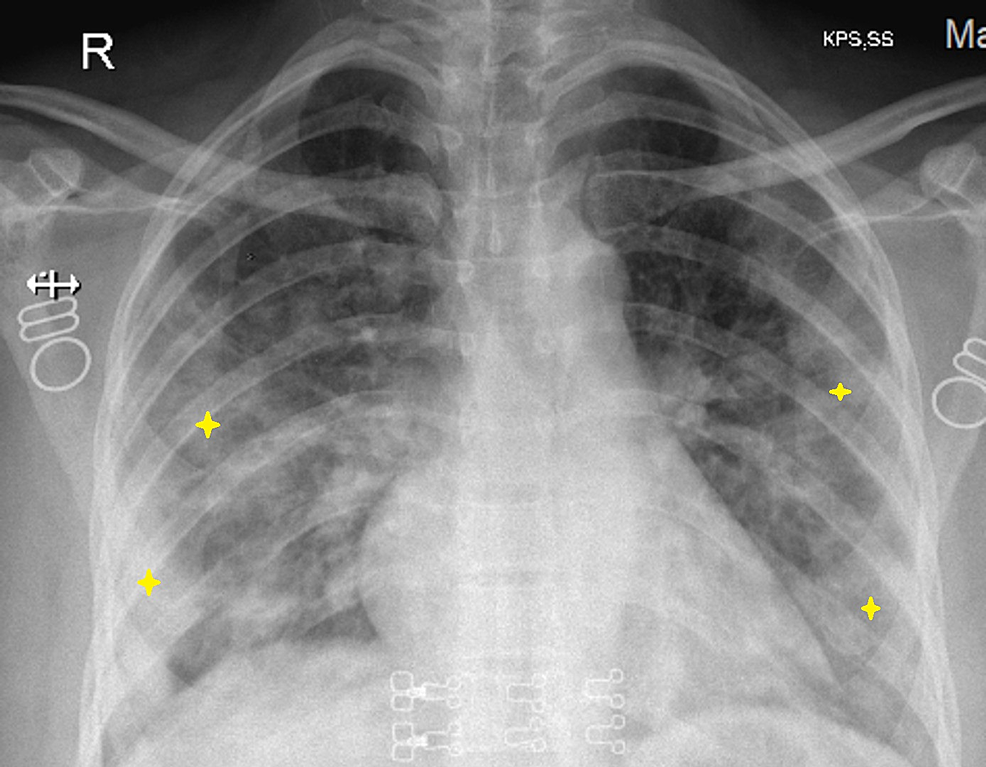 Cureus | Treatment With Remdesivir in Two Pregnant Patients With COVID ...