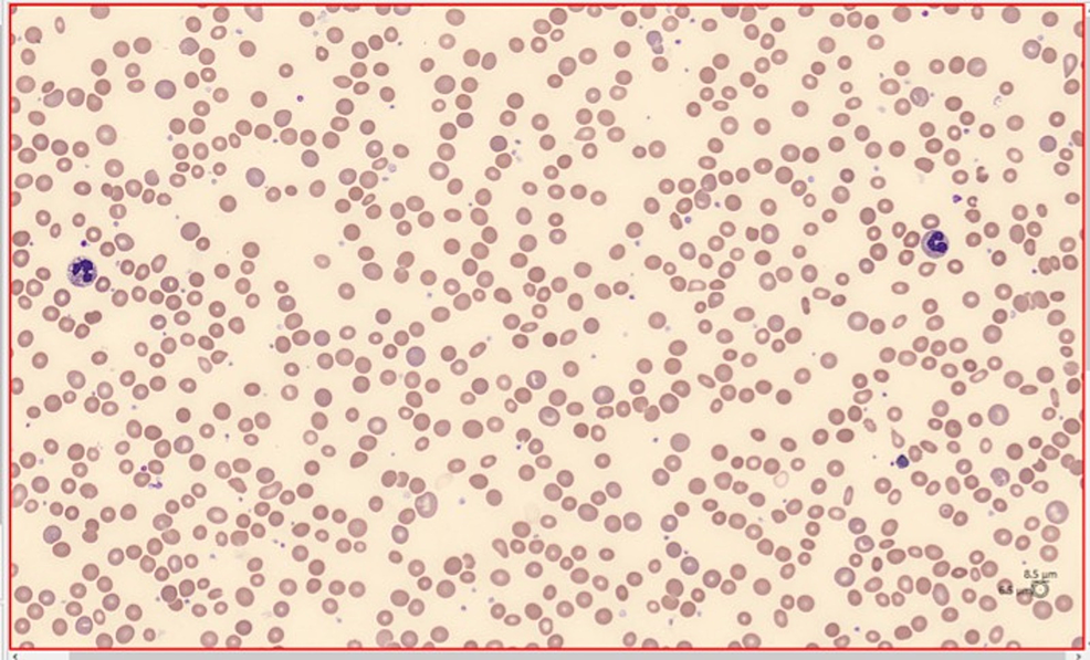 Peripheral-blood-smear-(May-Grunwald-Giemsa-staining)-with-normocytic-and-normochromic-anemia,-moderate-anisopoikilocytosis,-and-moderate-polychromasia