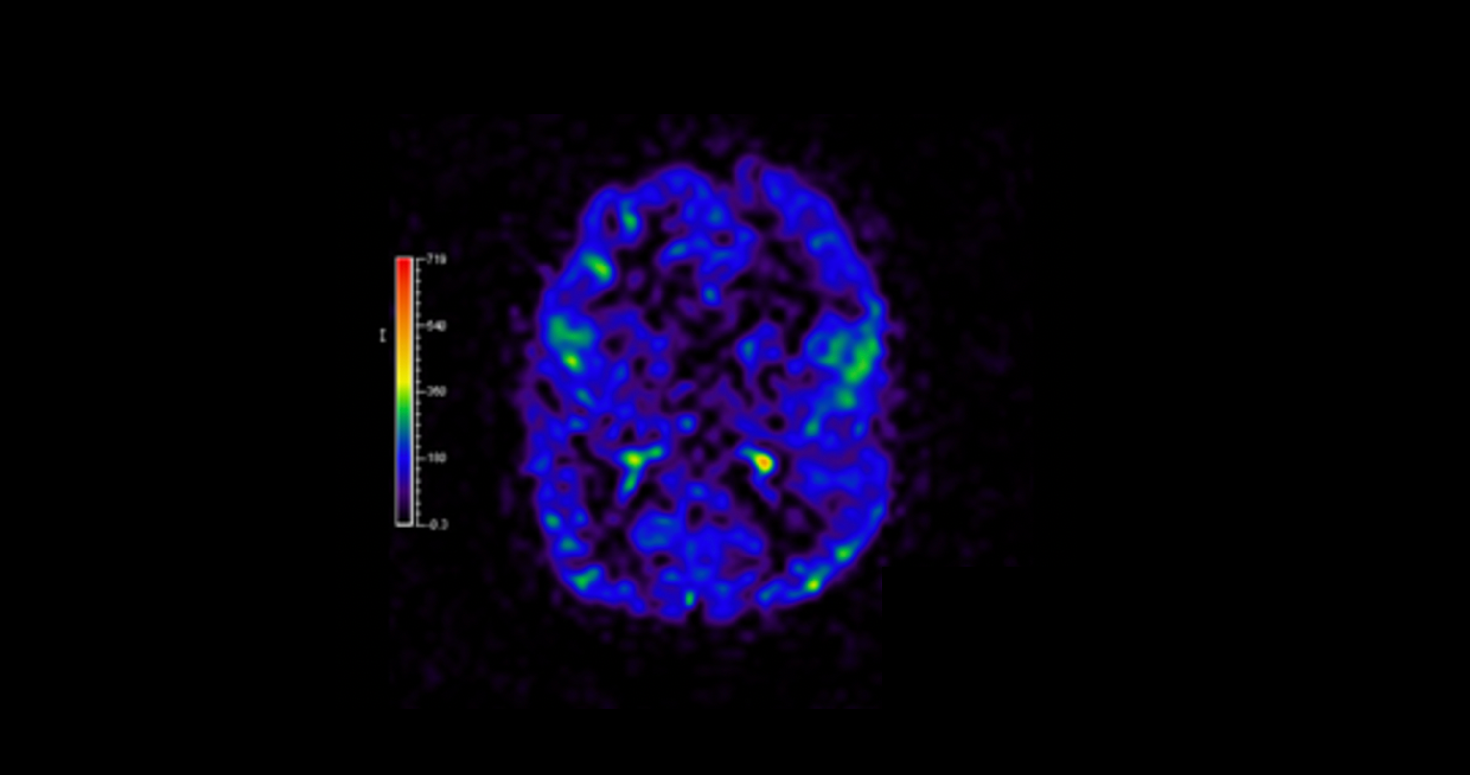 Cureus Megalencephaly Polymicrogyria Polydactyly Hydrocephalus Mpph A Case Report And Review Of Literature