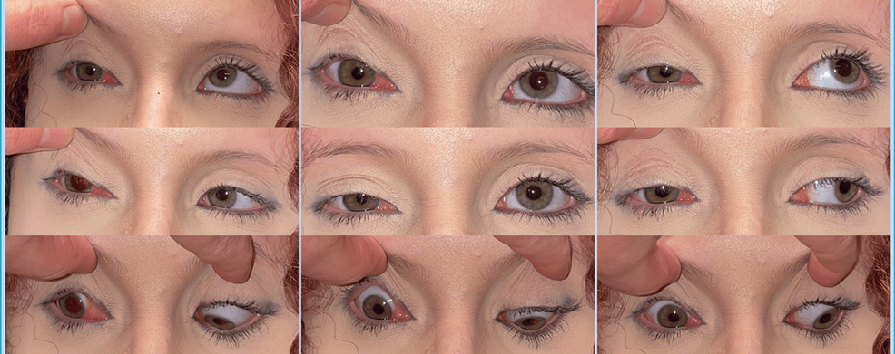 Cyclic oculomotor nerve palsy alters visual acuity and accommodation