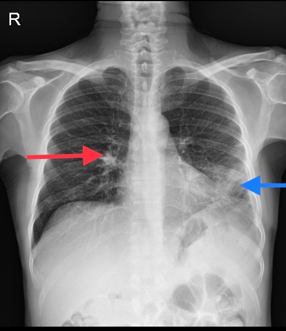 Pneumococcal Bacteremia and Cryptococcal Meningitis Dual Infection in a