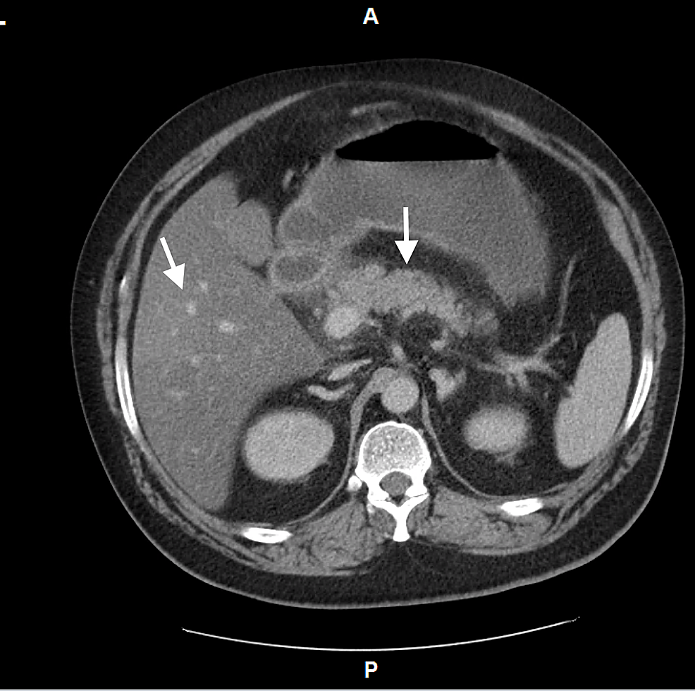 A Fatal Case of Hypertriglyceridemia-Induced Acute Pancreatitis in a ...