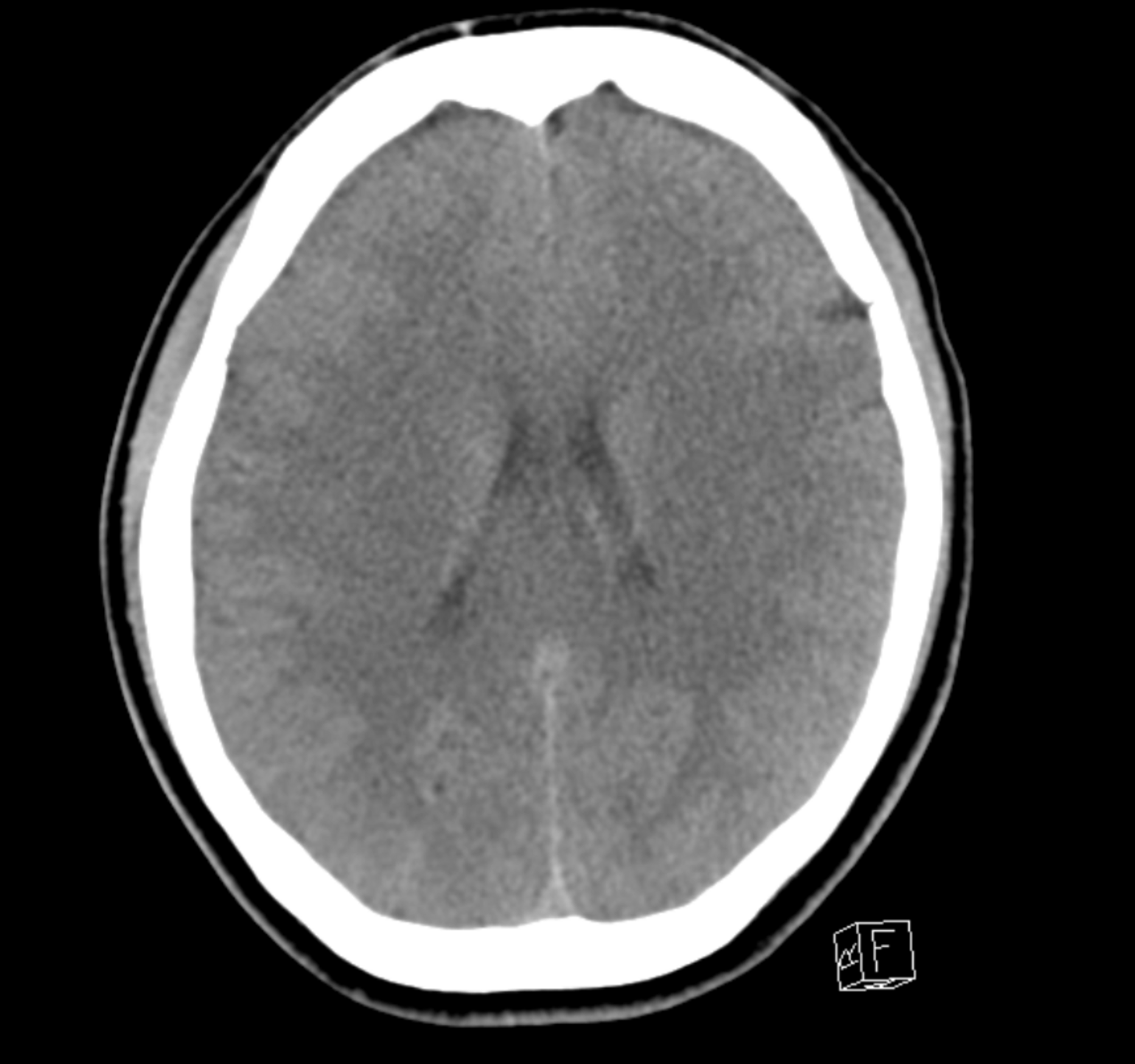 Cureus Methylenedioxymethamphetamine (MDMA)Induced Hyponatremia