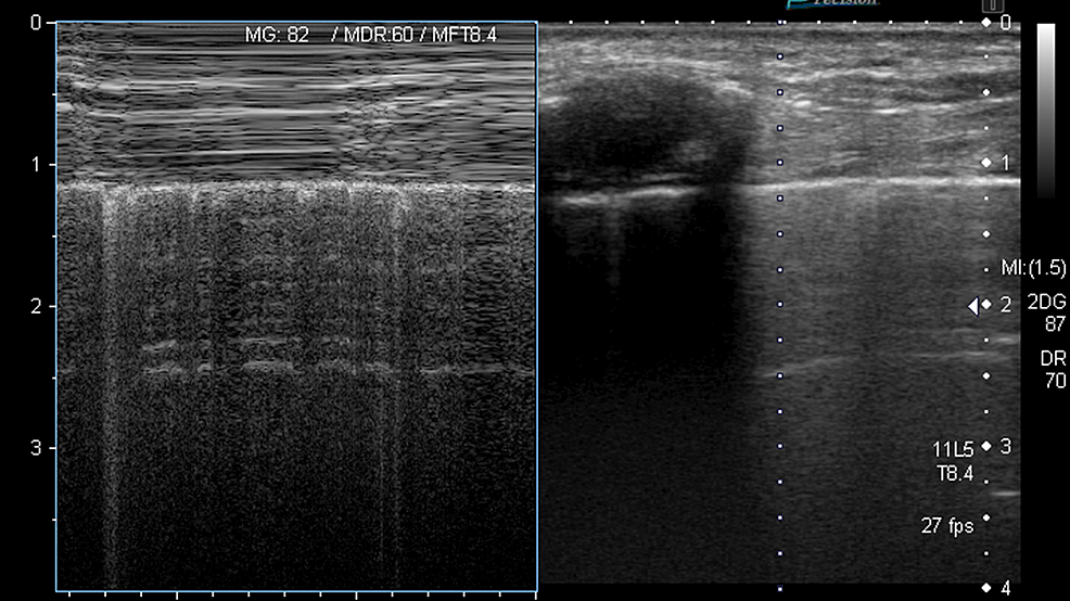 Cureus | Preoperative Lung Ultrasound To Detect Pleural Adhesions: A ...