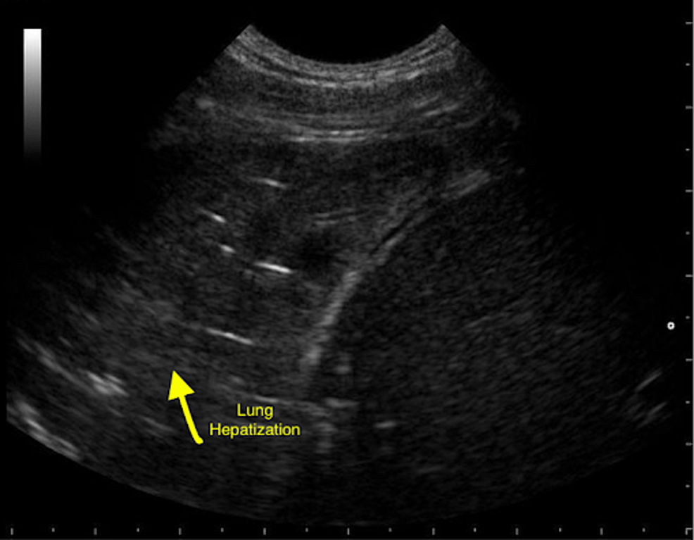 Ultrasound-of-the-lung-showing-hepatization-of-the-lung.-The-yellow-arrow-points-to-an-area-of-lung-hepatization-representing-consolidation-of-the-lung.