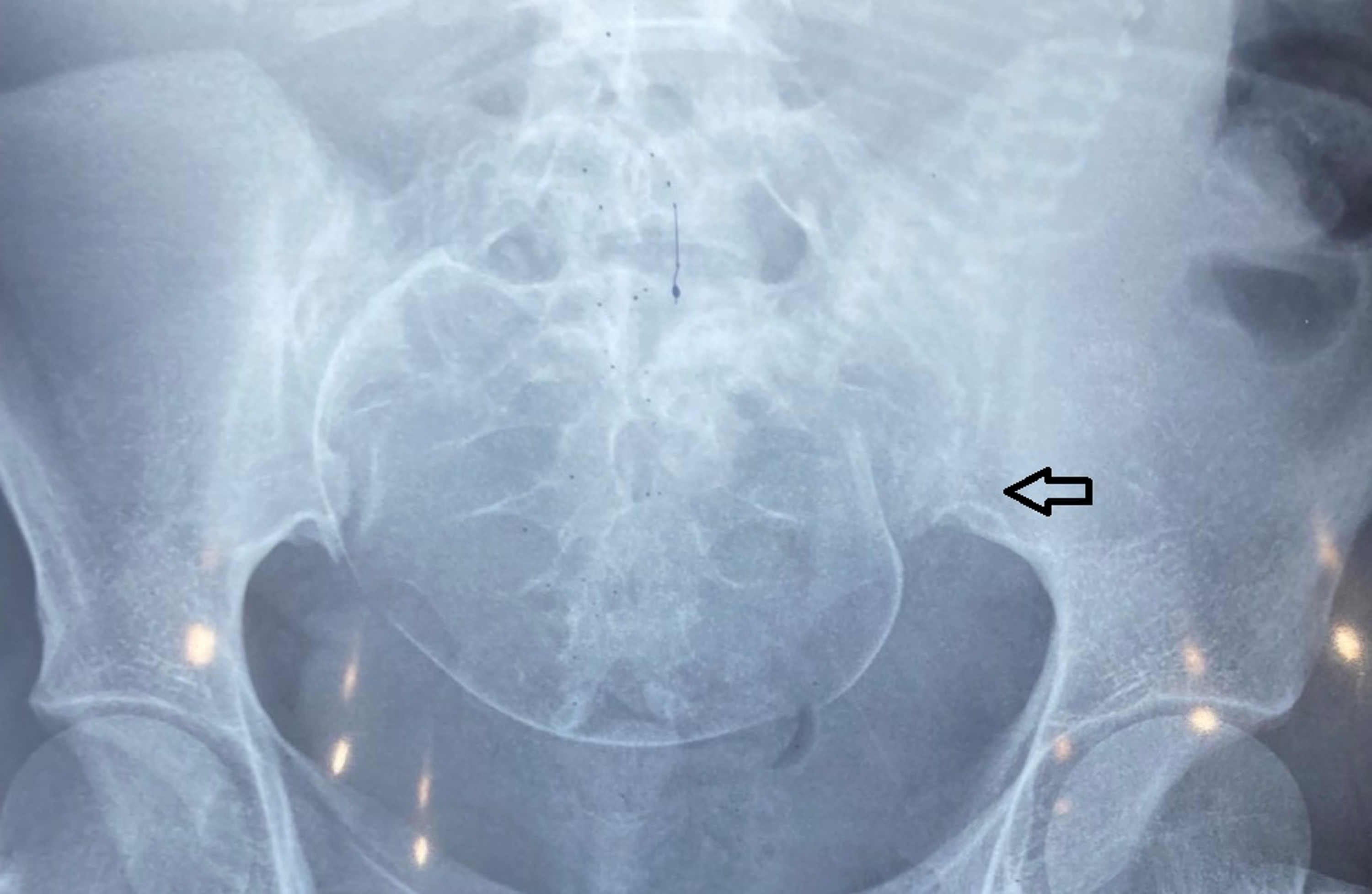 Cureus A Pregnant Patient Presenting With Unilateral Sacroiliitis