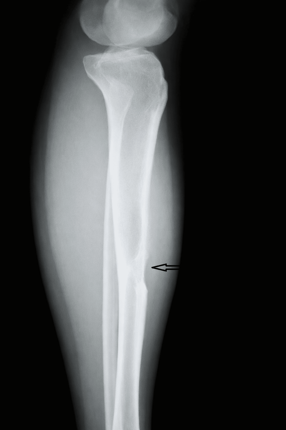 Management of Tibial Adamantinoma: Balancing Oncologic Cure and Reconstructive Longevity