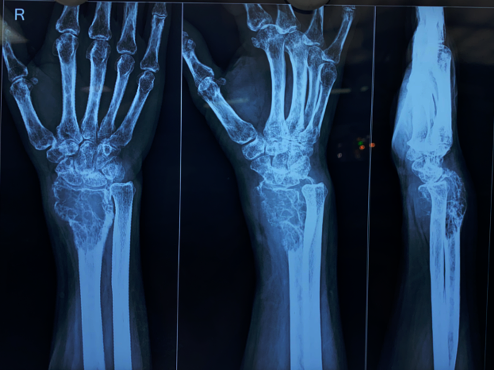 cureus-giant-cell-tumor-of-the-distal-radius-wide-resection-ulna