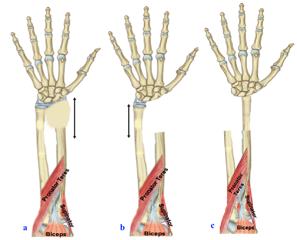 Cureus | Giant Cell Tumor of the Distal Radius: Wide Resection, Ulna