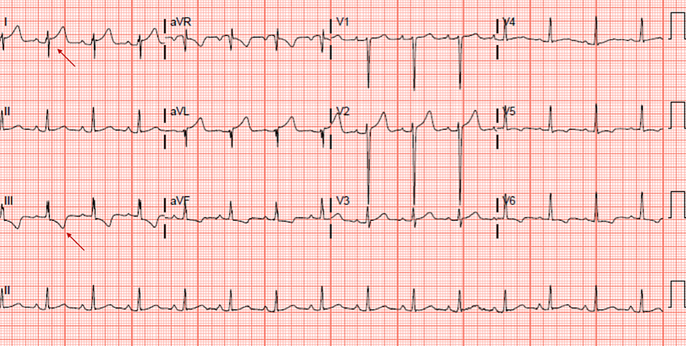 Cureus | Catheter-Related Right Atrial Thrombus Requiring Surgical ...