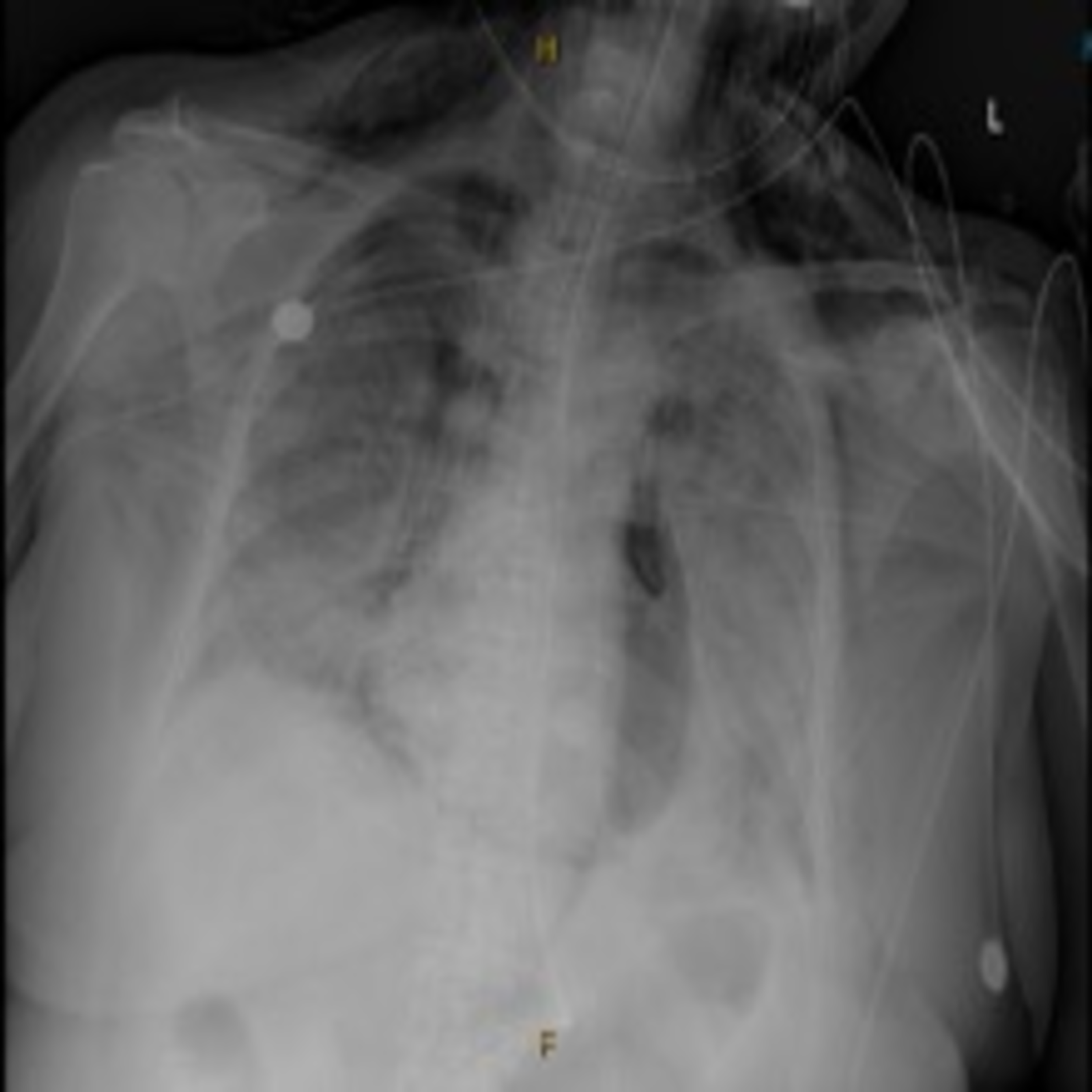 COVID19 Associated Spontaneous Pneumothorax and Pneumopericardium A
