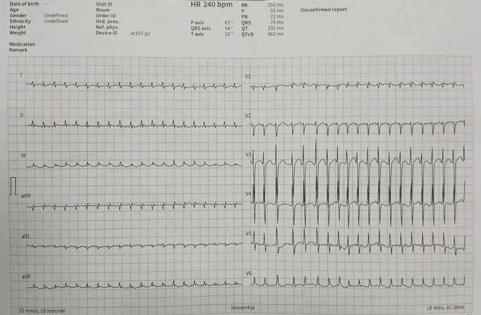 Extracardiac Mediastinal Mass Presenting With Cardiac Arrhythmias: A Case Report