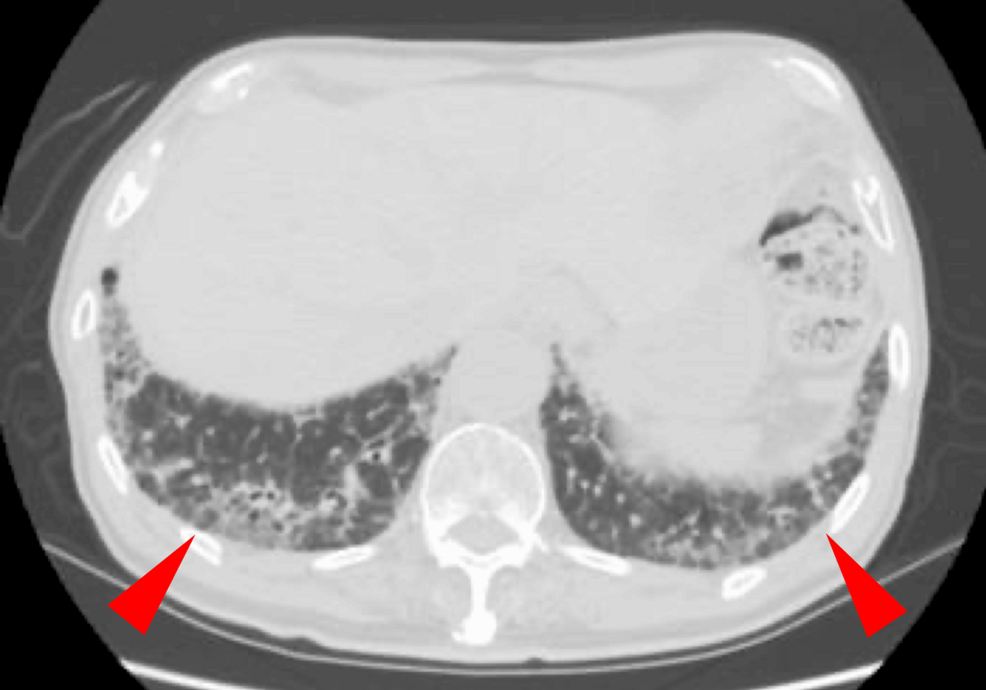 Acute Exacerbation of Previously Unrecognized Interstitial Lung Disease in a Functionally Independent Nonagenarian: A Case Report