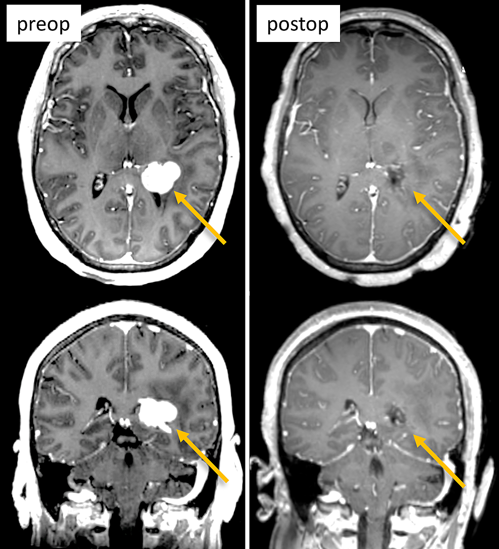 Pre--and-postoperative-MRI-(T1-with-contrast,-axial-top-row,-coronal-bottom-row)-showing-the-lesion-in-the-apex-of-left-lateral-ventricle-(left-column,-arrows)-and-gross-total-resection-(right-column,-arrows).