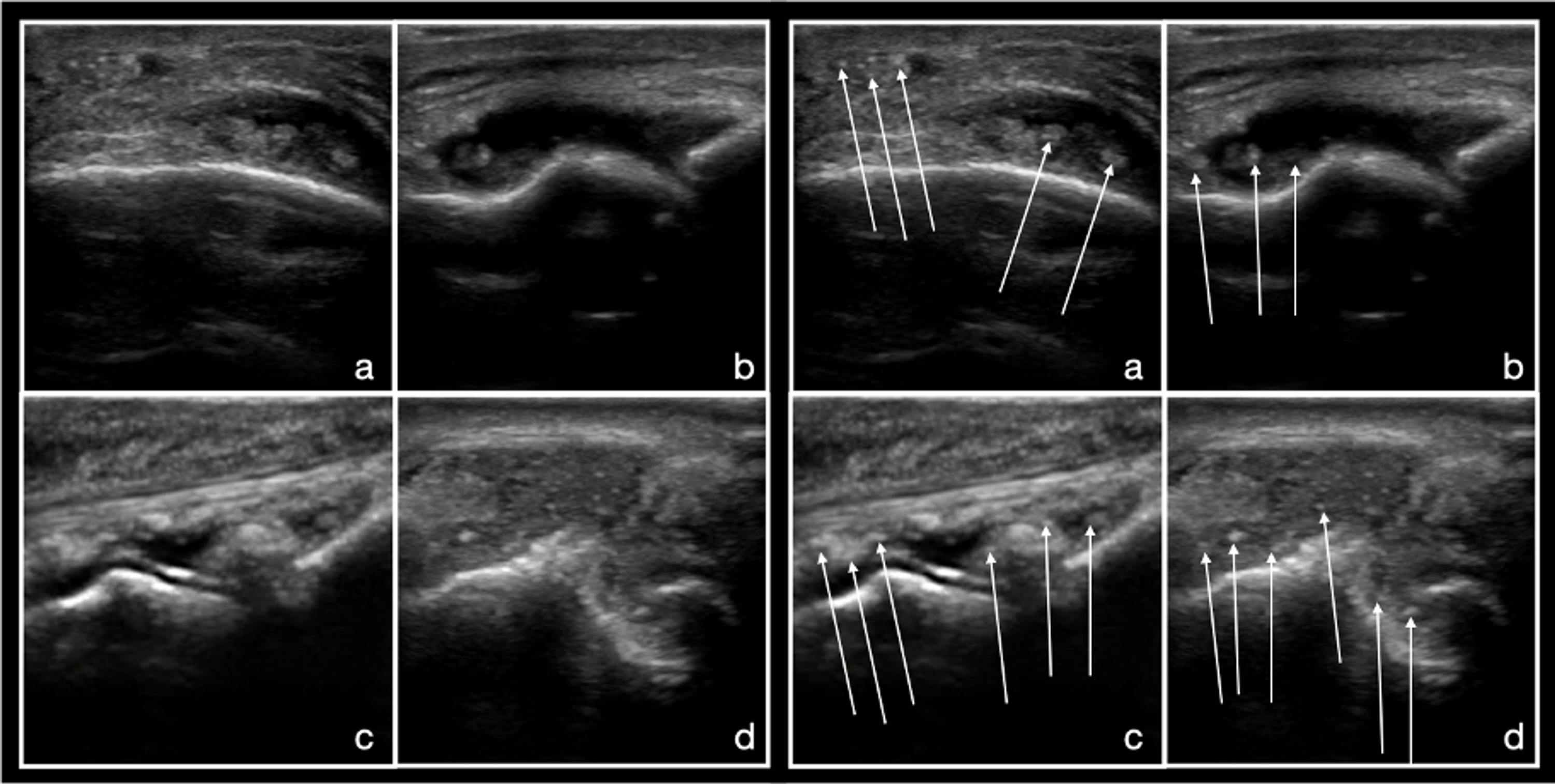 Cureus Images in Primary Care Medicine PointofCare Ultrasound in Gout