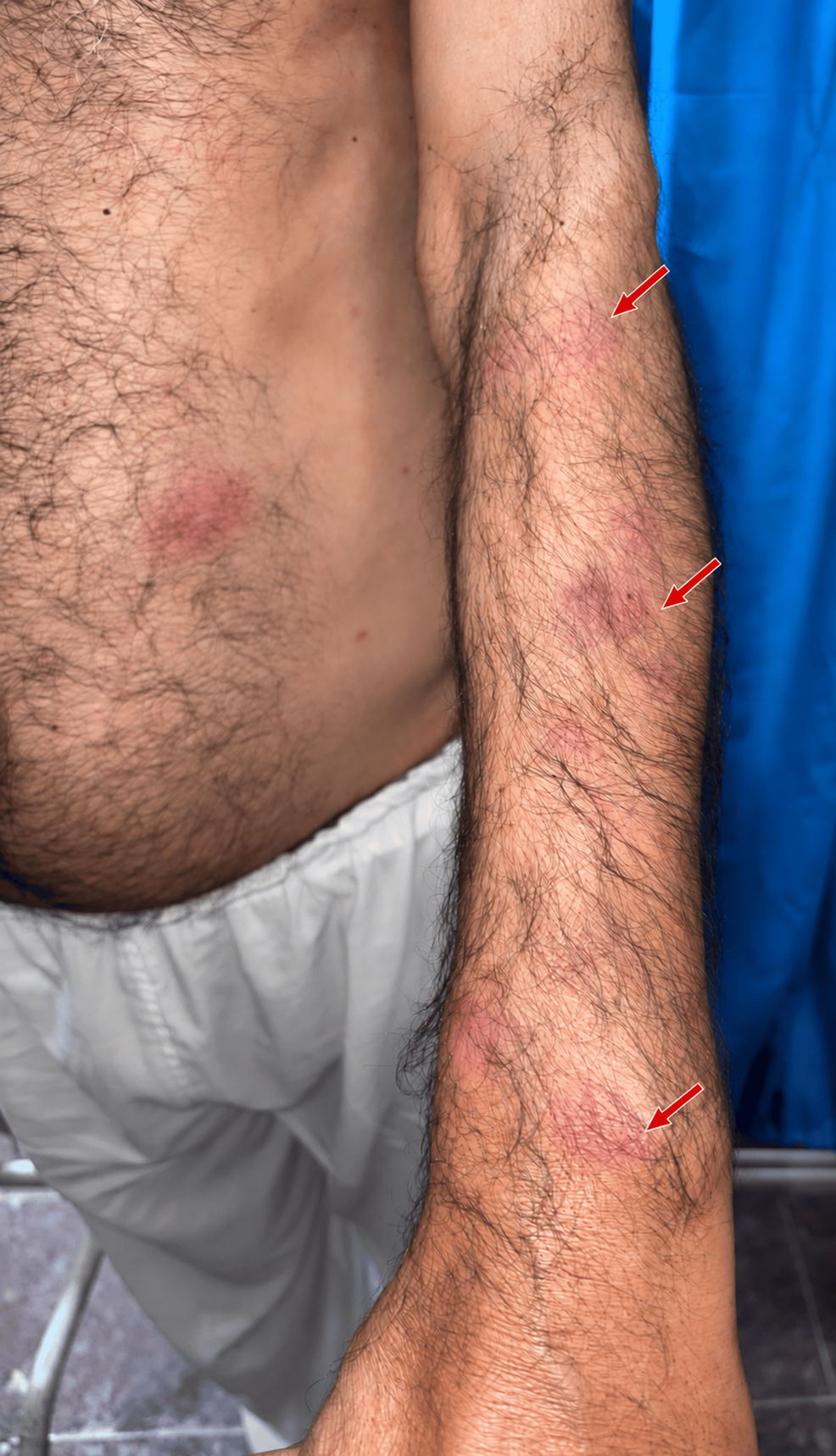 Case Report Describes Leprosy Misdiagnosed as Probable CIDP