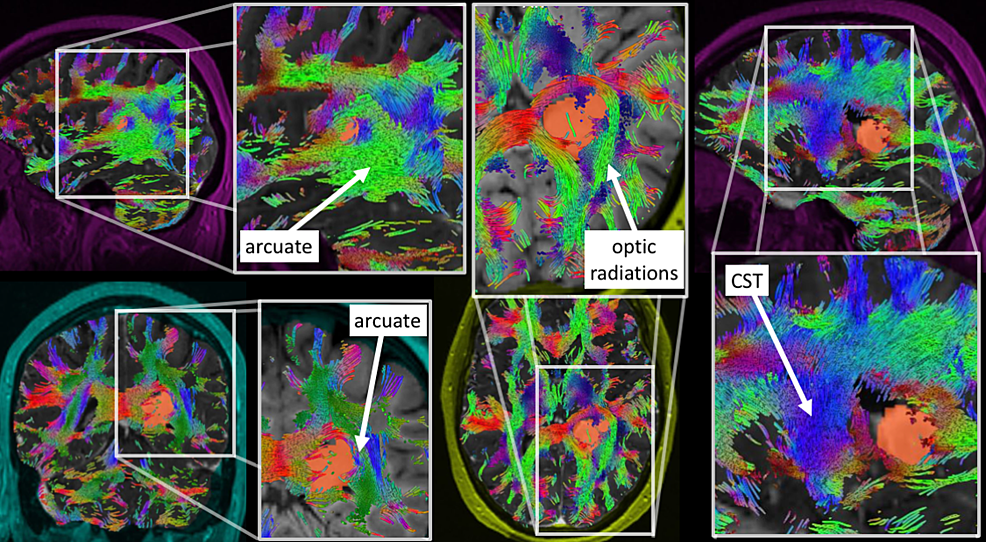 Projected-views-of-tumor-(orange)-with-surrounding-white-matter-pathways-(colors):-acuate-fasciculus,-optic-radiations,-and-corticospinal-tract-(CST)