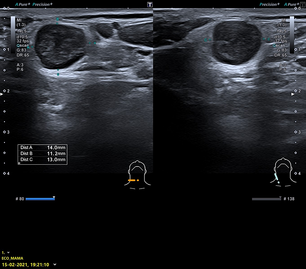 Cervical-ultrasonography---February-15,-2021