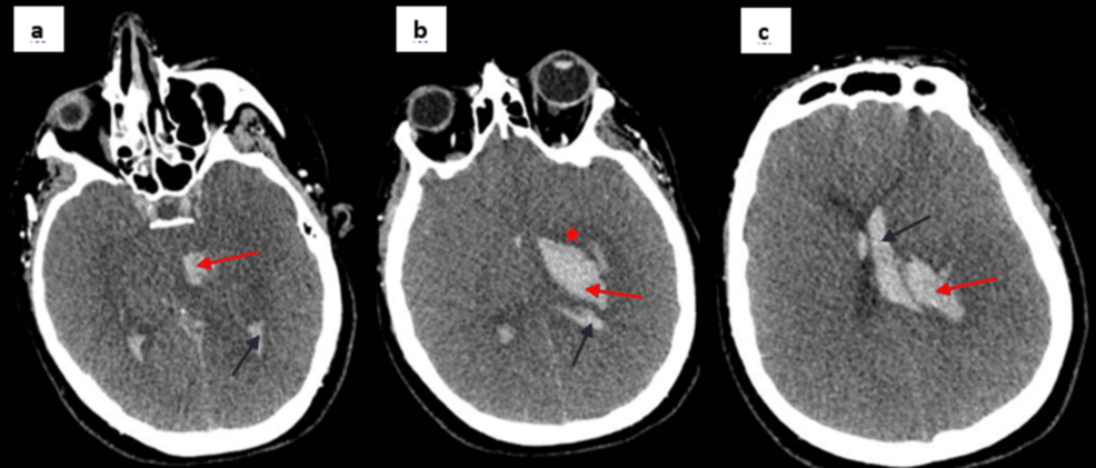 Fatal Intracerebral Hemorrhage Linked to AstraZeneca COVID-19 Vaccine in Pregnant Woman - News Directory 3