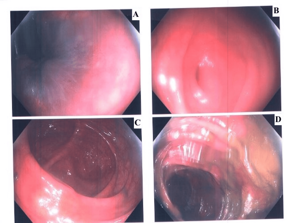 Adult Intussusception After Screening Colonoscopy: A Case Report - News Directory 3