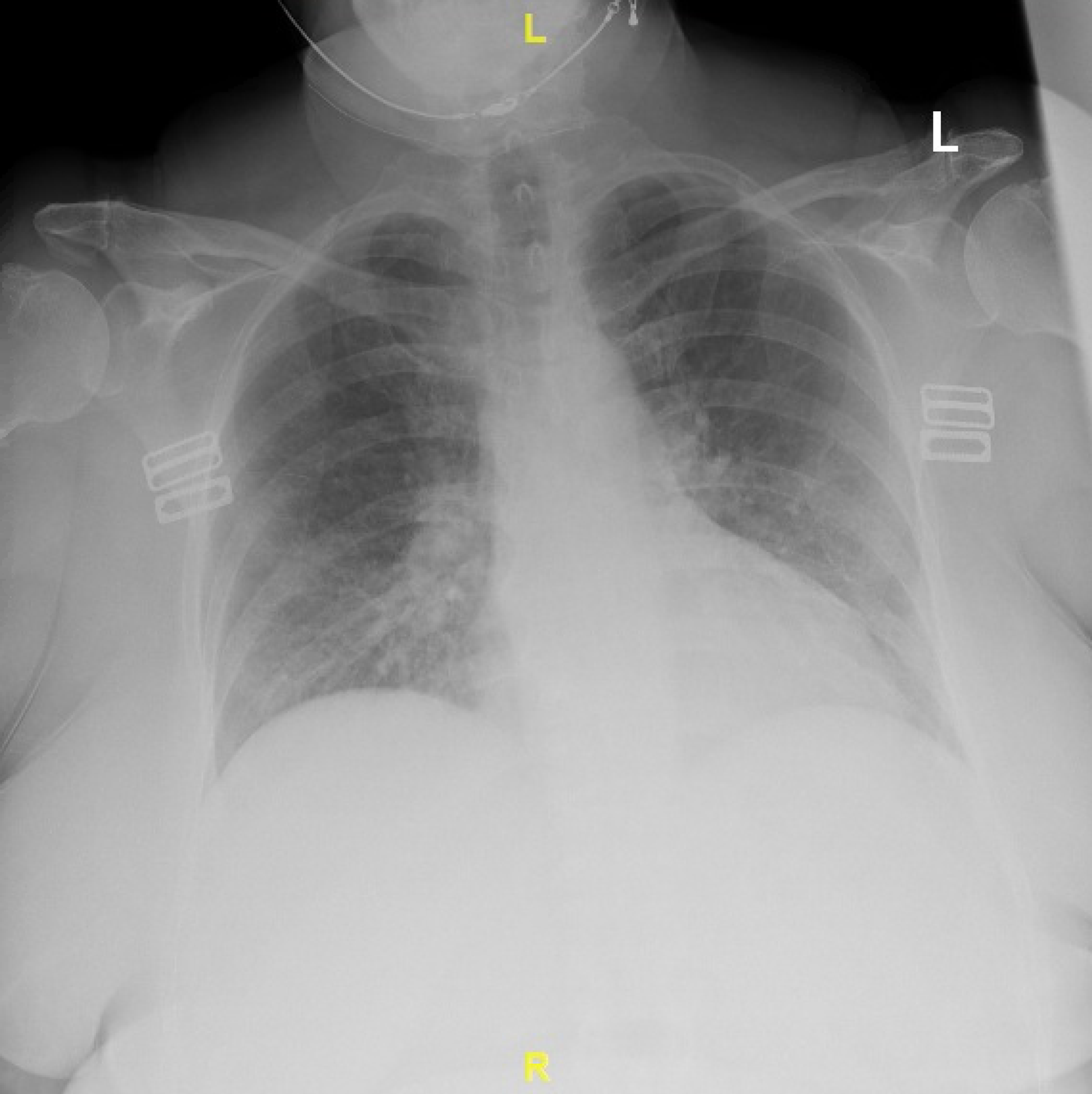 Cureus Acute Myeloid Leukemia Complicated by Hyperleukocytosis and