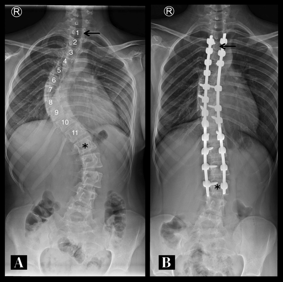 Preoperative Recognition of Vertebral Variations in Scoliosis
