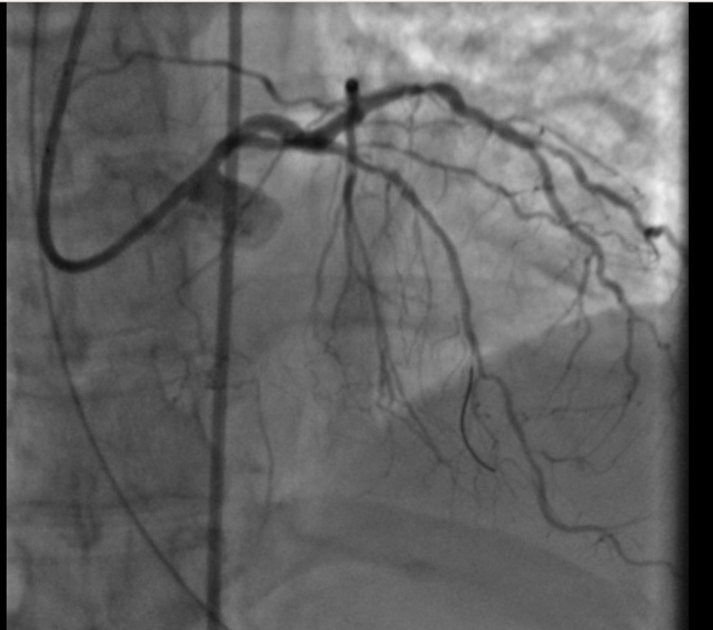 percutaneous transluminal coronary angioplasty (ptca)