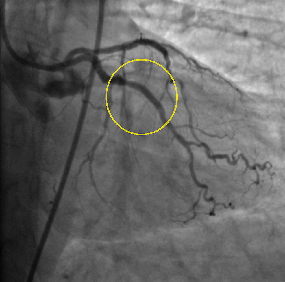 Successful Percutaneous Balloon Angioplasty in a Patient Presenting