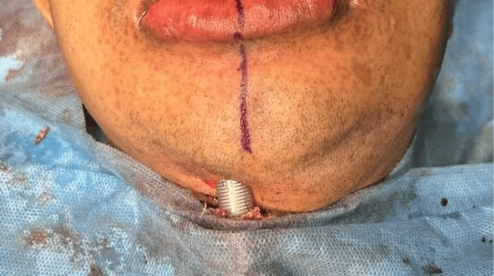 Clinical-photograph-demonstrating-submental-intubation-with-the-endotracheal-tube