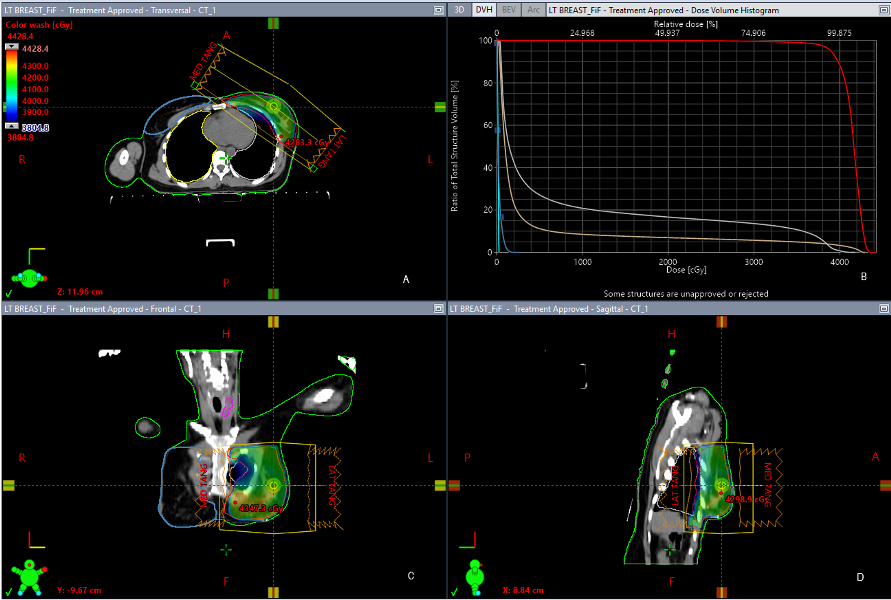 Cureus Dosimetric Comparison of Whole Breast Radiotherapy Using Field