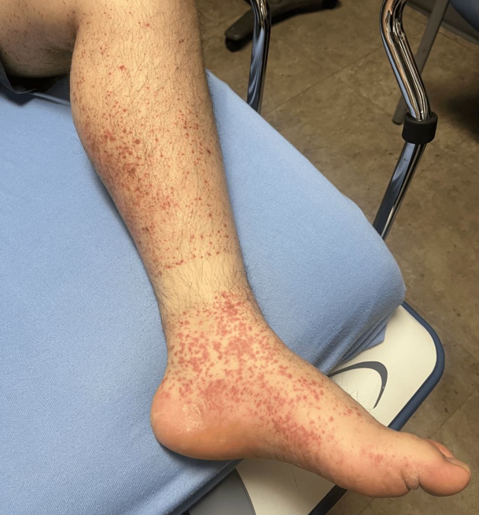 Acute Febrile Multisystem Illness With Vasculitic Features in a Young Adult: A Diagnostic Challenge Between Infectious and Autoimmune Etiologies