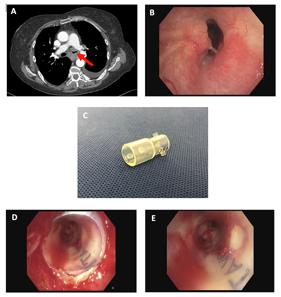 Single-Use Endoscopic Y-Shape Tracheal Stents