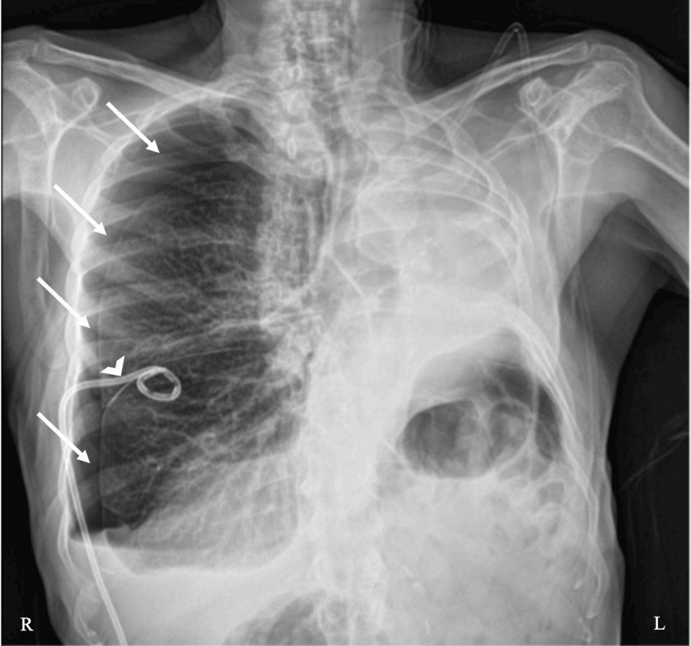 Preoperative-chest-radiograph