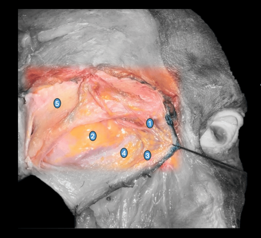glutathione injection protocol Ocular Adipostructuring in Complications From Orbital Fillers: Managing the Orbital Base Hi-Tech Pharmaceuticals L-Glutathione 60 thin skin Length:12mm