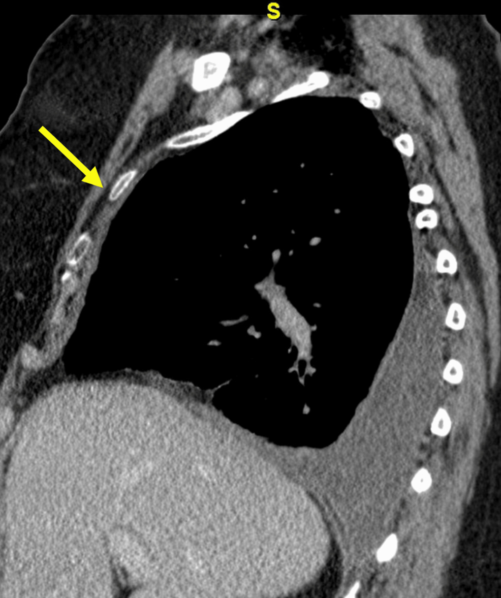 Rheumatoid Pleuropulmonary Disease Mimicking Refractory Empyema: A