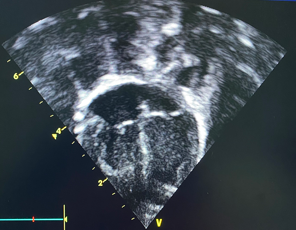 Cureus Kawasaki Disease Shock Syndrome in the Eastern Region of Saudi