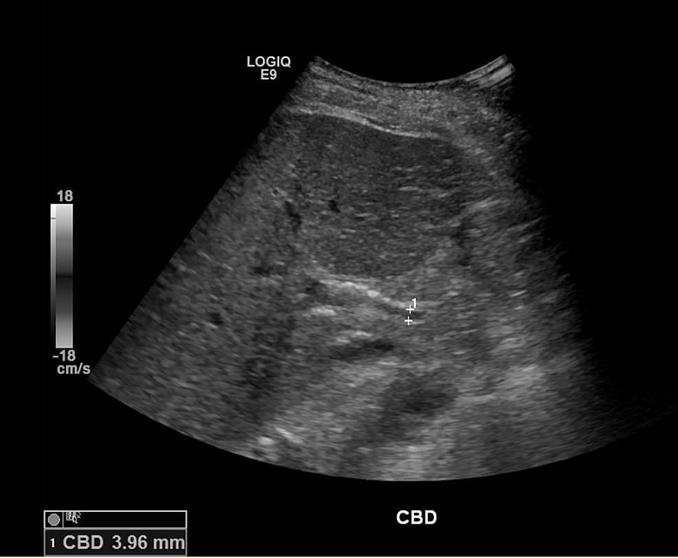 Acute Liver Failure From Sickle Cell Hepatopathy Treated With Exchange ...