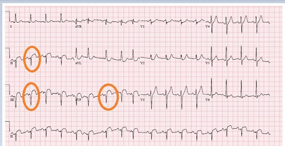 abnormal q suggests anterior infarct