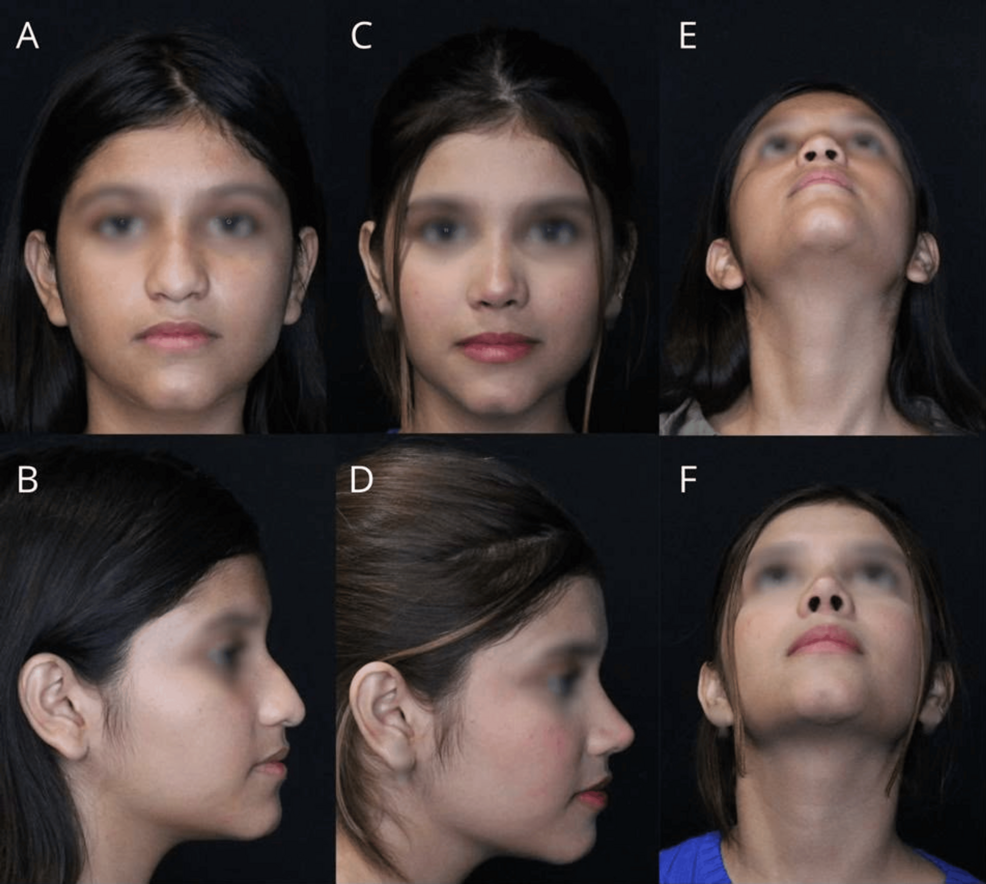 Patient-with-intermediate-thickness-skin.-(A)-Preoperative-frontal-view.-(B)-Preoperative-right-lateral-view.-(C)-Postoperati