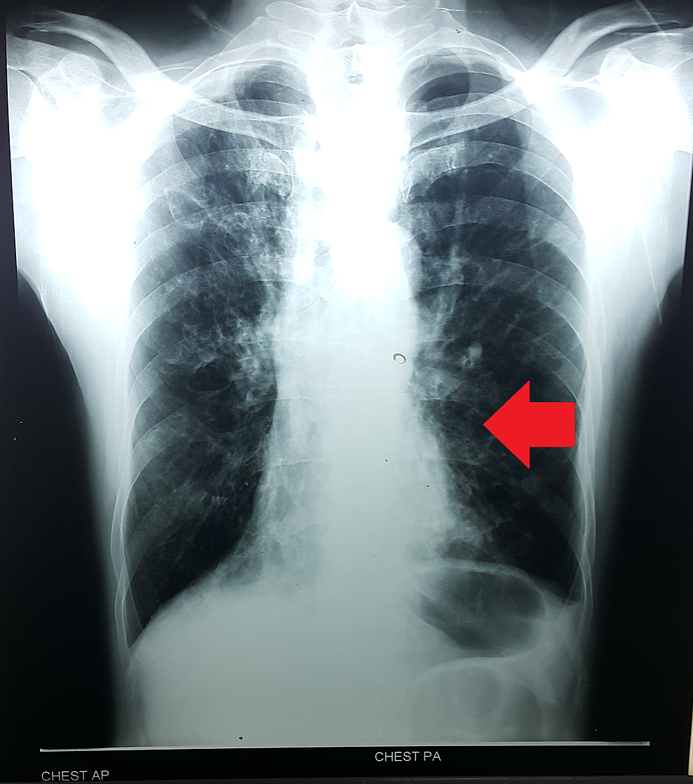 Chest-x-ray-showing-mild-cardiomegaly-with-pulmonary-congestion-and-dextrocardia