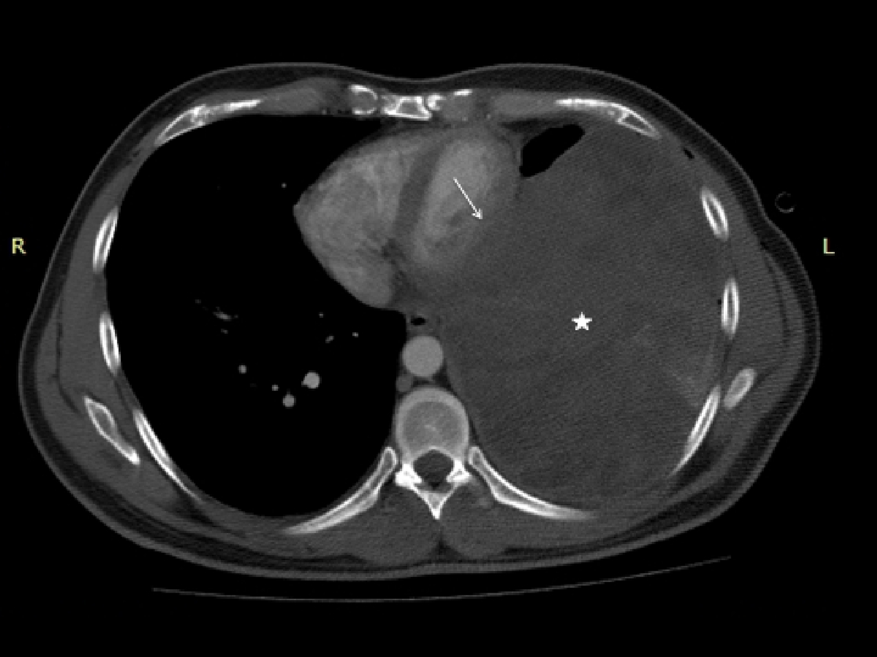 Cureus | Primary Extraosseous Ewing’s Sarcoma Of The Lung: Radiologic ...