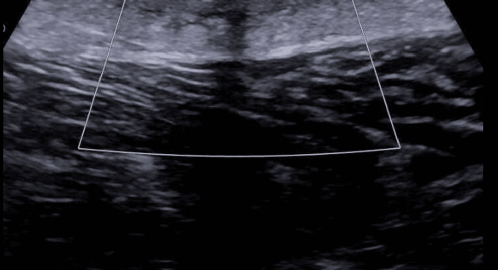 Ectopic Pilonidal Disease as Anterior Leg Swelling: Case Report