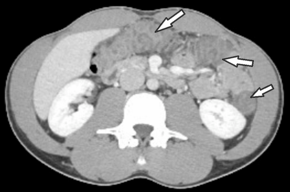Amoxicillin-Clavulanate-Induced Ischemic Colitis: A Rare Case Study - News Directory 3