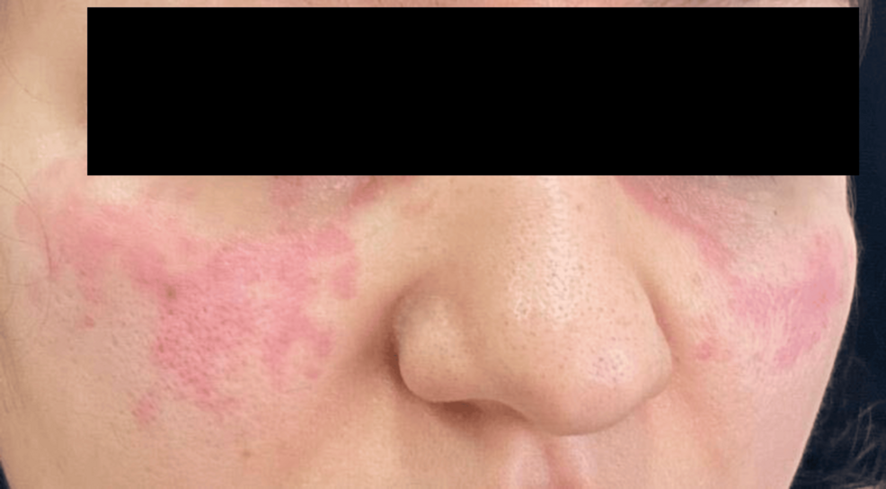 Photo: Cureus Tirzepatide Linked to Suspected Biphasic Anaphylaxis in Case Report