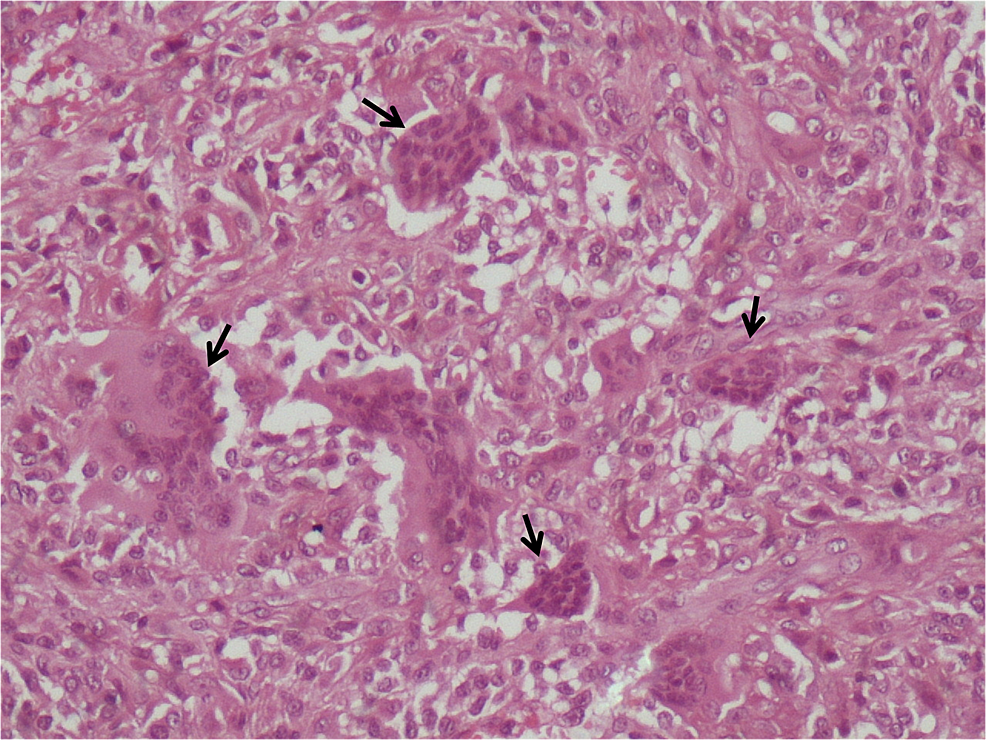 Histopathological-examination-shows-the-multinucleated-giant-cells-(H&E,-X400)-
