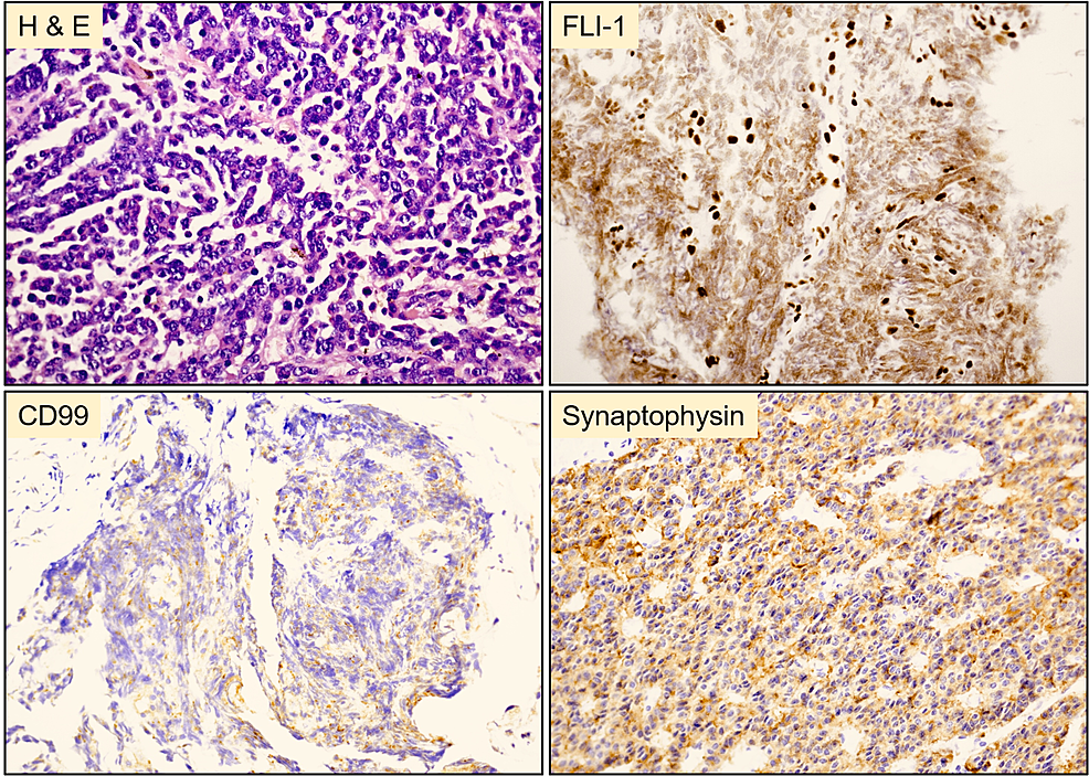 Histopathology-of-the-resected-tumor-from-the-stomach