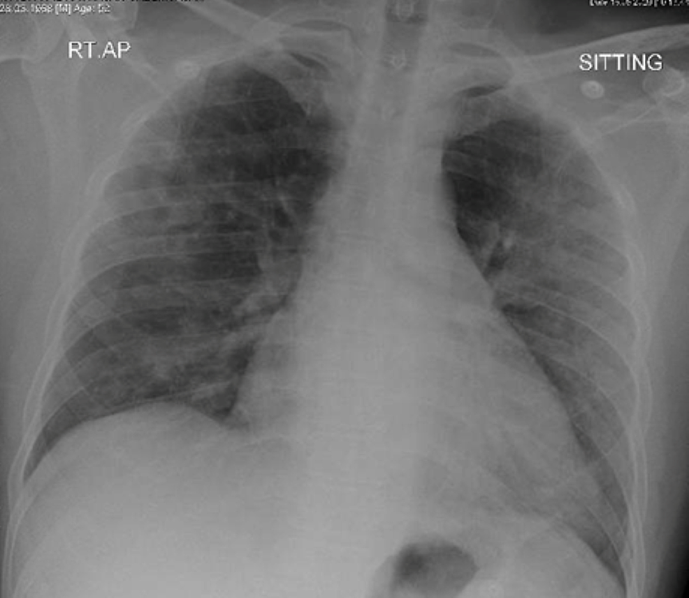 -Bilateral-predominantly-peripheral-alveolar-infiltrates-with-loss-of-left-hemidiaphragm-silhouette-on-anteroposterior-chest-X-ray