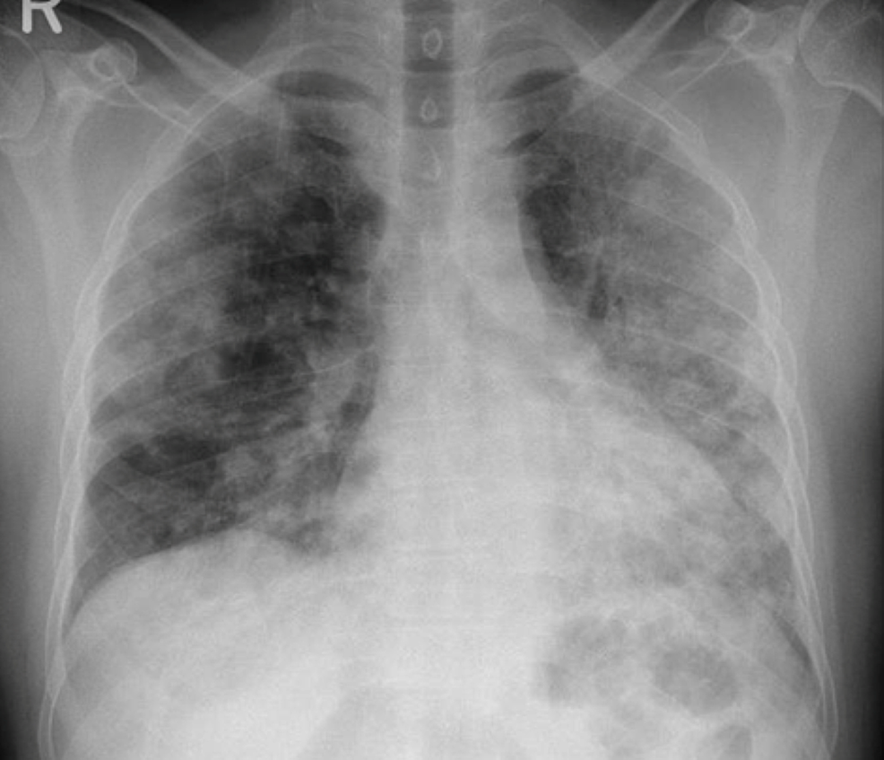 Progression-of-the-bilateral-pulmonary-consolidation-on-chest-X-ray