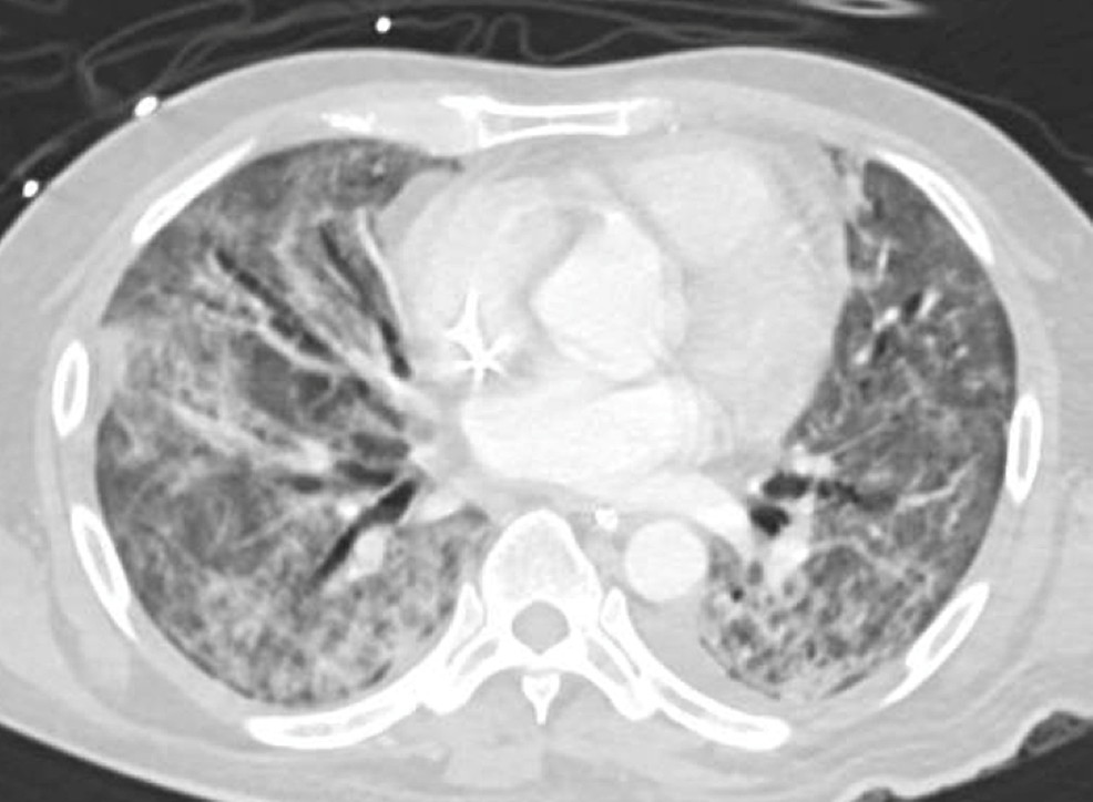 CT-chest-showing-bilateral-consolidation-and-ground-glass-opacities-with-air-bronchogram-and-evidence-of-bronchiectasis-more-on-the-right-side